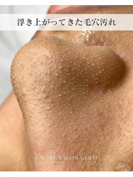 ゴールド 栄店(GOLD)/【毛穴洗浄パック後】