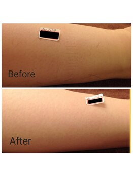 サロン ピューパ(Salon pupa)/女性膝下脱毛　before→after