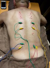 このは接骨院/背中～腰のしつこいだるさに鍼☆