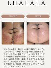 モモ(momo)/大人気ニキビケア◎