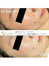 エスプリ 銀座店/ハーブピーリング銀座