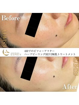 エスプリ 銀座店/ハーブピーリング銀座