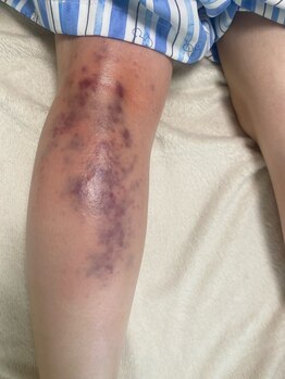 コル コルエ(koru korue)/座りっぱなしの方は膝裏が危険