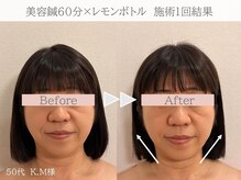 ネテマテ 表参道(netemate)/美容鍼×レモンボトル