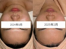 カレンジェビューティー(CarengeBeauty)/小顔矯正コルギ