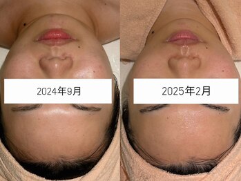 カレンジェビューティー(CarengeBeauty)/小顔矯正コルギ