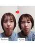 【2週間限定 先着5名様】食いしばりを根本から整える★美容鍼灸×整体約105分