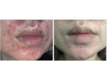 キキ(kiki)/白玉ピコジェットB/A