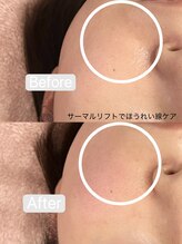 リンダ 西宮店(LINDA)/サーマルリフトRF