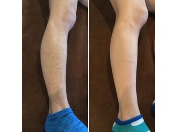 ルーチェ/【脱毛箇所】ひざ下