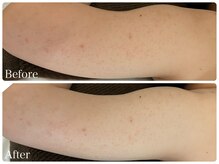 ブリエ(Briller)/二の腕ハーブピーリング♪