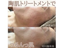 ルクー(RuCoeur.)の雰囲気（陶肌トリートメント１回の前後写真です！年齢によるお悩みにも◎）