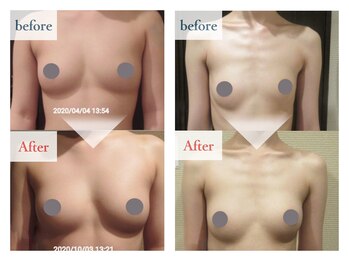 PMK ルグラン 町田店(Le Grand)/バストケア施術前後比まとめ