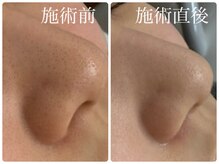 シェミー(CHEZ MEE)/【即実感】毛穴洗顔・イオン導入