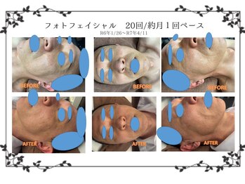 磨凛/光フェイシャル