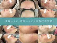 エステ ニキビケア研究所 川崎店