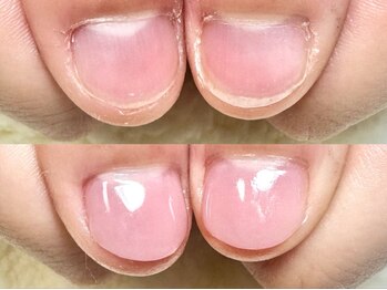 グラシナ なんば店/深爪/自爪育成/フィルイン