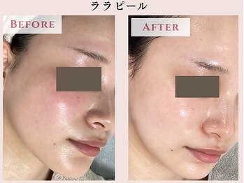 レクラ バイ ドクターエイチ(L'ECLAT by Doctor.H)/ララピール