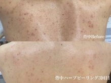 beauty salon LALA 大阪南森町｜ハーブピーリング・肌質改善・インディバの雰囲気（ブライダルに人気◎背中ハーブピーリング）