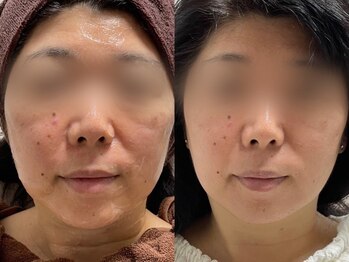 サクラ 伊勢原店(SAKURA)/フェイシャルエステ以上の効果