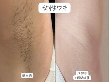 セルフメイド 東大阪店(SELFMADE)/女性ワキ脱毛♪BeforeAfter