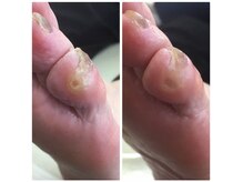 厚木 海老名 巻き爪矯正センター/事例【ドイツ式フットケア】