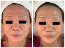 ホノカ(HOnoKA)/EMS+表情筋ほぐし