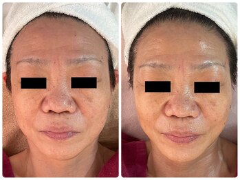 ホノカ(HOnoKA)/EMS+表情筋ほぐし