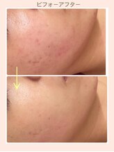 リファイン(REFINE)/ハーブピーリングでニキビ改善！