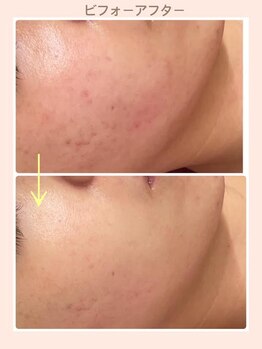 リファイン(REFINE)/ハーブピーリングでニキビ改善！