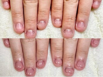 グラシナ なんば店/深爪/自爪育成/フィルイン