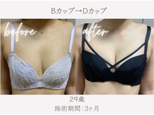 ハリスタ 京橋院(HARISTA)/BEFORE AFTER【バストアップ】