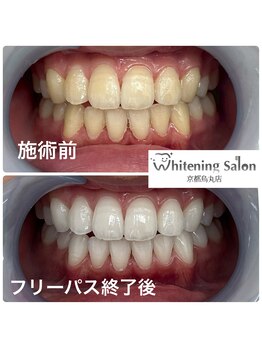 ホワイトニングサロン 京都烏丸店/ホワイトニング施術例