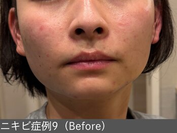 オアシスラグーン(OASIS LAGOON)/ニキビ改善(症例9 before)