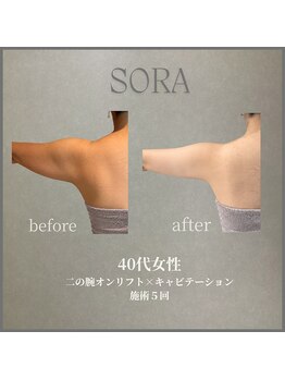 ソラ 天神 大名(SORA)の写真/ノースリーブを着こなす二の腕へ｜最大出力オンリフト×キャビで二の腕・ハミ肉を集中ケア