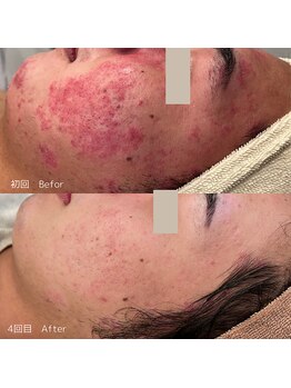 ハル(haru)/ビフォーアフター