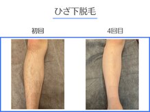 エクシアホワイトニング 岡崎店/最新脱毛機！効果を実感◎