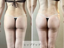 アージェム(AGEM)/【痩身】ハイパーナイフ、吸引