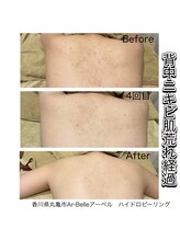 アーベル(Ar-Belle)/背中ニキビ改善角質ピーリング