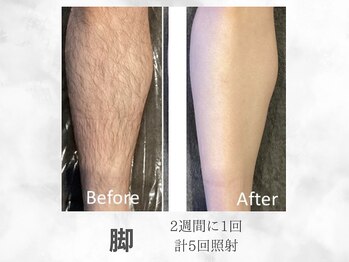 ベル(Belle)/メンズ脚脱毛