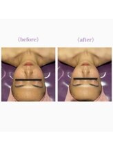 ライゼ(REISE)/ビフォーアフター【美白/小顔】