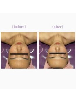 ライゼ(REISE)/ビフォーアフター【美白/小顔】