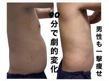 ジール(ZEAL)/痩身/ダイエット　１回のお客様