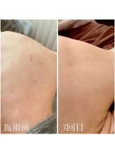 フォア(foi)/背中ハーブピーリング