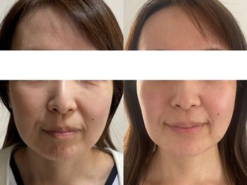 サクラ 伊勢原店(SAKURA)/フェイシャルエステ以上の効果