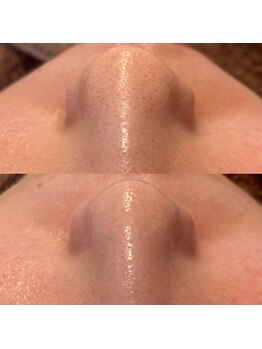 アール(ar.)/毛穴洗浄フェイシャル