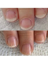 シーネイル(C Nail)/平たい爪にカーブができる