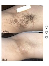 ペア(pe'a)/脱毛before★after[脇]