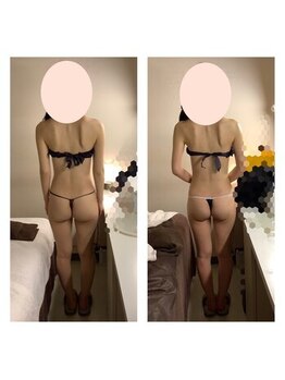 アクア エステティコ 亀有(ACQUA estetico)/ヒップアップ美尻小尻