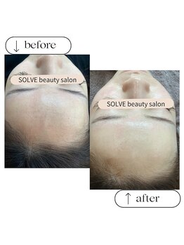 ソーヴ(SOLVE)/ピーリング/シェービング/毛穴